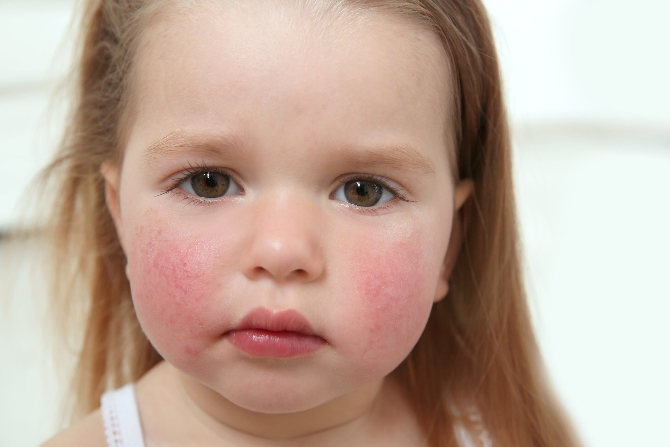 Natural Solutions For Eczema